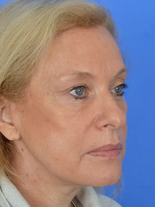 quarter view of a female patient before deep plane face lift