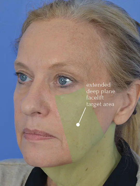 quarter view of a female patient after deep plane face lift