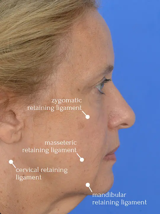 profile view of a female patient before deep plane face lift