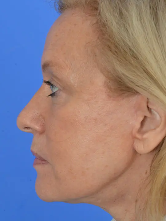 profile view of a female patient after deep plane face lift