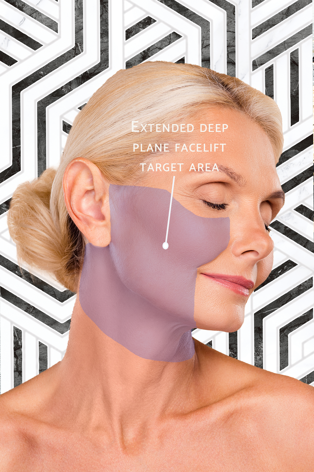 extended deep plane facelift target area
