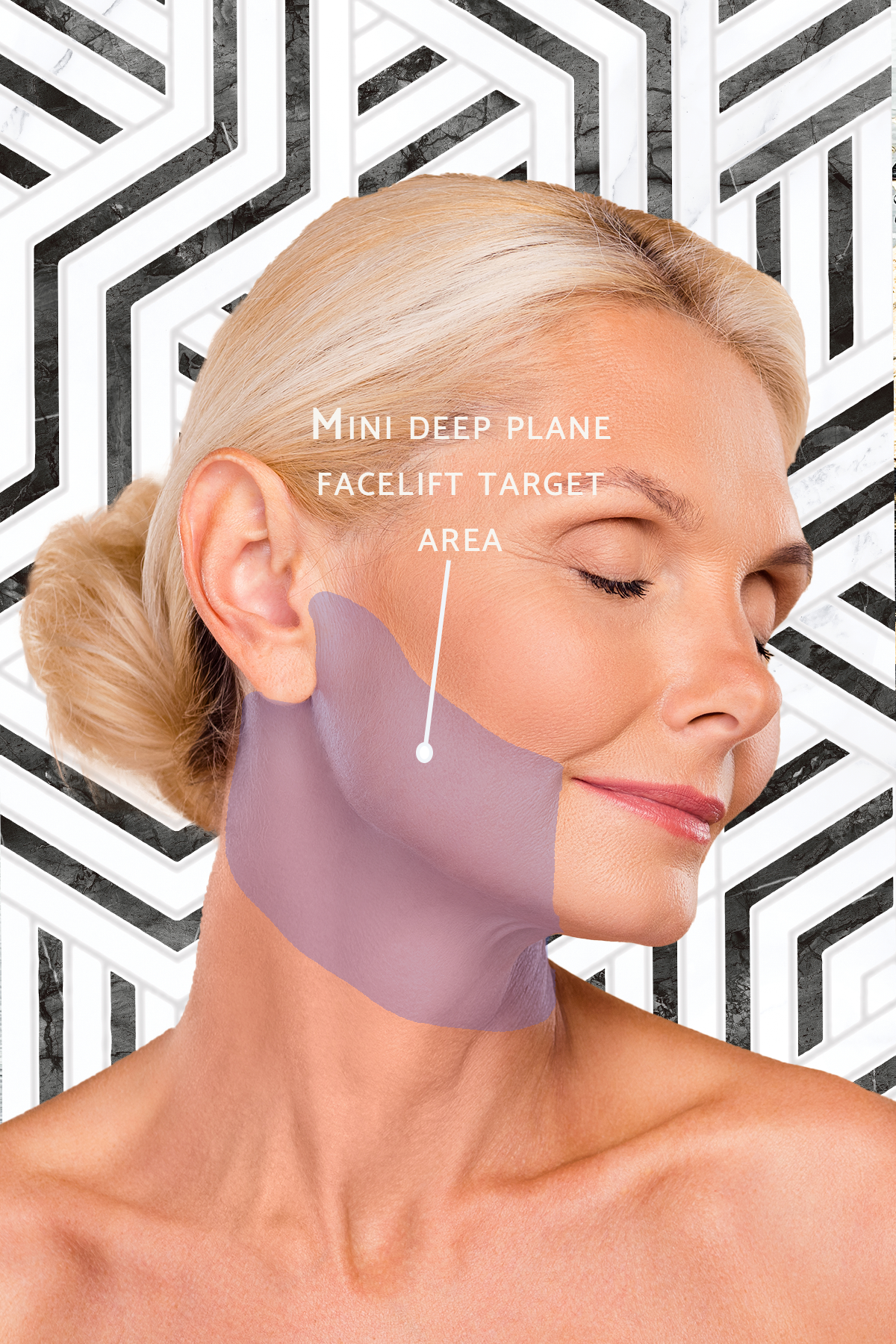 mini deep plane facelift target area