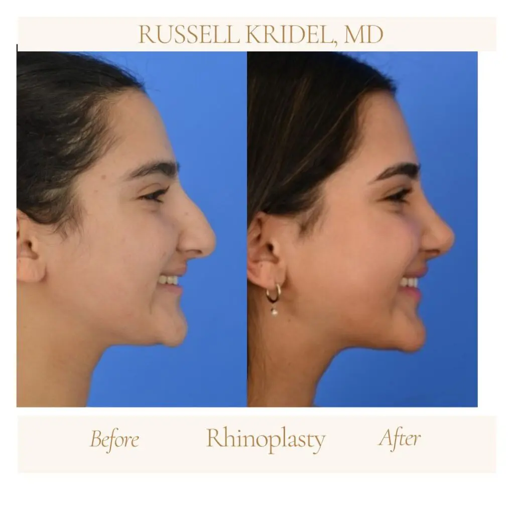 Before and after rhinoplasty results by Dr. Russell Kridel in Houston, TX.