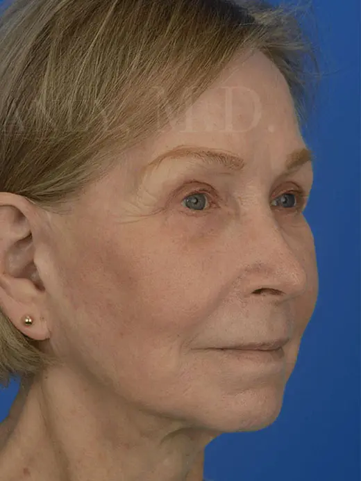 CO2 Laser Skin Resurfacing Loose Skin Facial Wrinkles 90226 Oblique Right Post Treatment