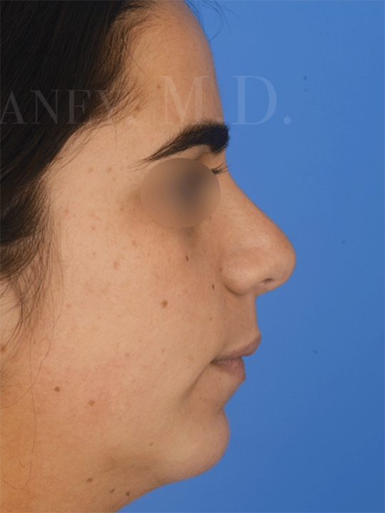 Thick-skin-rhinoplasty-to-improve-breathing-and-reduce-nasal-size-in-Houston | After Chin Augmentation