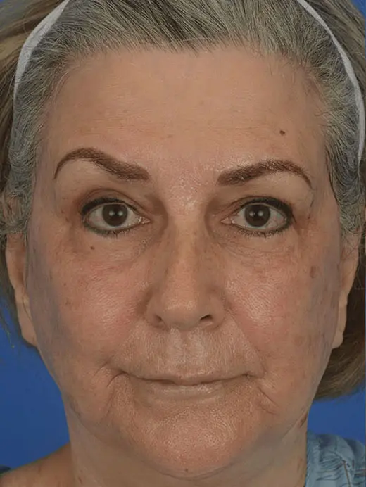 Laser Skin Resurfacing Loose Skin Facial Wrinkles CO2 Laser 90959 Front View Before Treatment