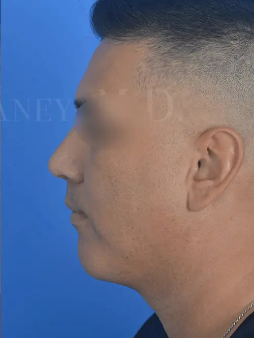 Rhinoplasty-and-lower-face-sculpting-for-adult-male-in-Houston | After Morpheus 8