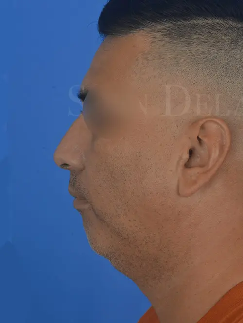 Rhinoplasty-and-lower-face-sculpting-for-adult-male-in-Houston | Before Morpheus 8