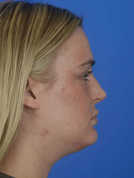 Patient Before & After Photo
