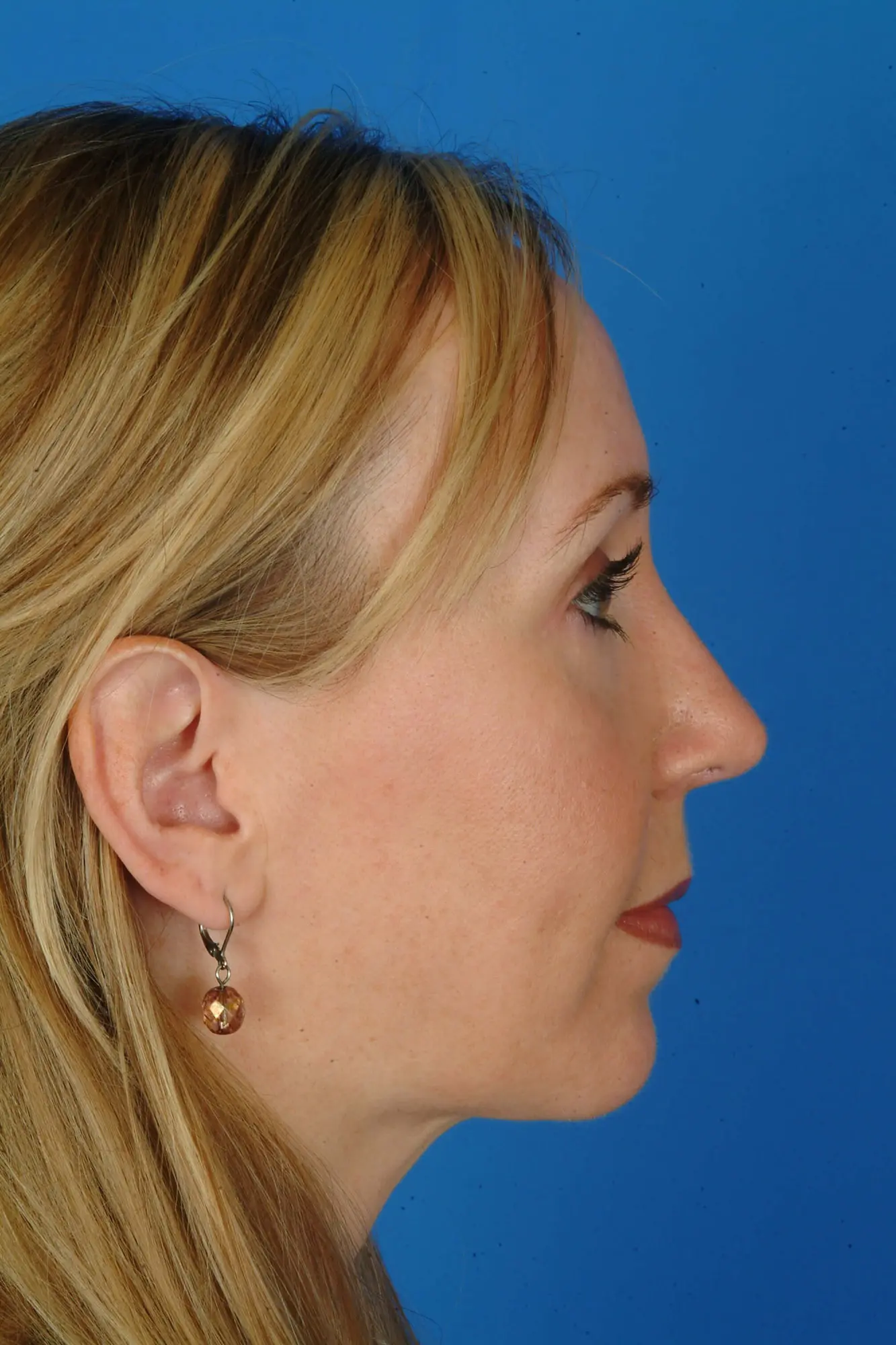 Rhinoplasty and Chin Augmentation 7386 2 Years Post Op 