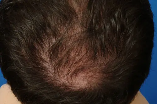 Before: Micrograft Transplant 2918 Hair Restoration Treatment