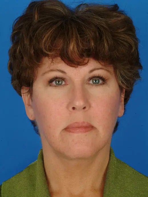 Facelift & Eyelids. 2927 front view 3 mos Post-op