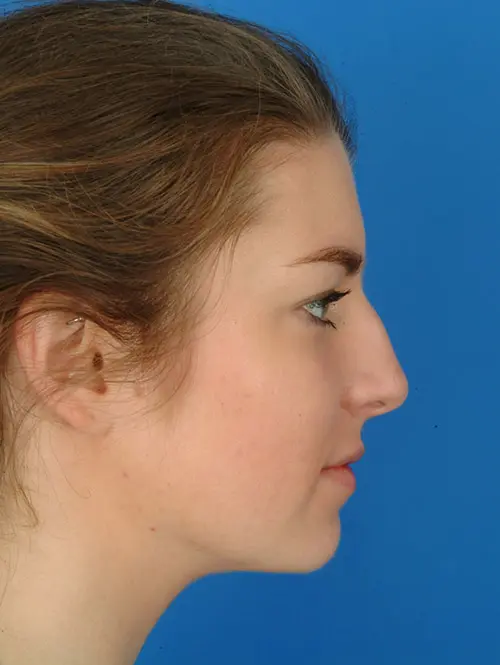 2952 Rhinoplasty Profile Before