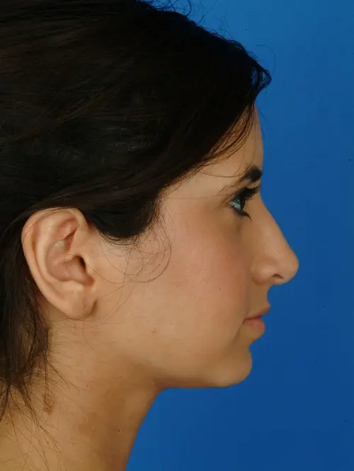 Ethnic rhinoplasty 2957 After 9 months post op Profile View