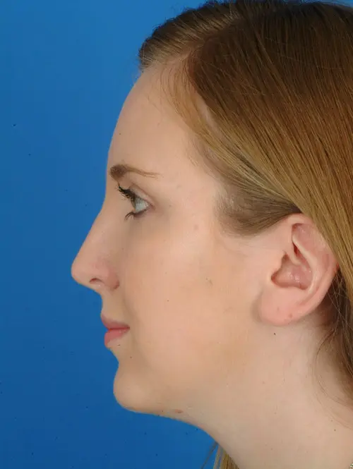 Rhinoplasty with Chin Implant 2958 Profile After 