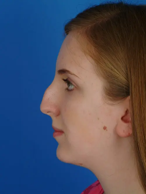 Rhinoplasty with Chin Implant 2958 Profile Before 