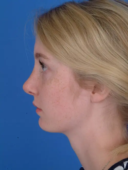 Rhinoplasty 8001 Profile After
