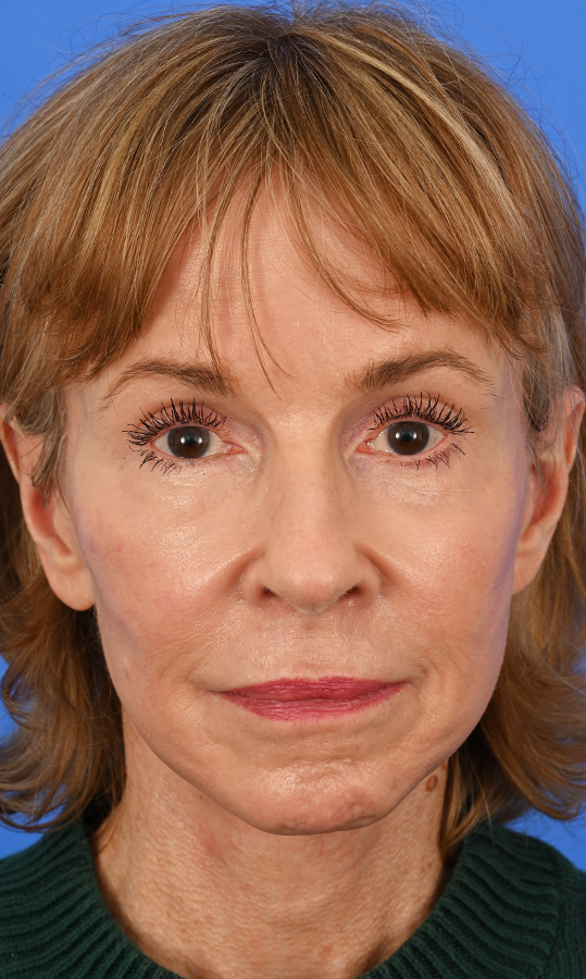 Case--9699 | After Central Neck Lift