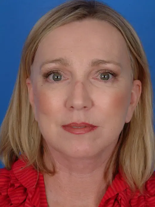 Facelift Chin Augmentation Eyelid Surgery Brow Lift. 9583 front view post op