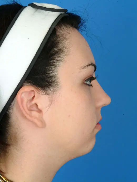 Submental Liposuction Chin Augmentation Neck Liposuction Chin Implant 64068 Profile Pre Op