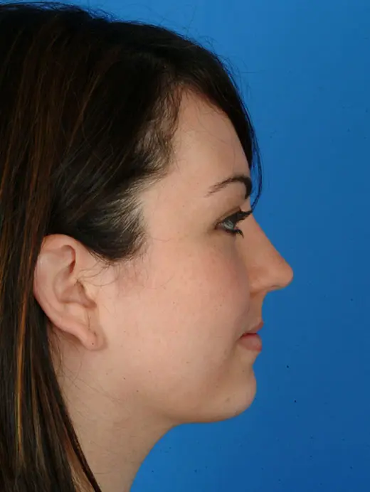 Submental Liposuction Chin Augmentation Neck Liposuction Chin Implant 64068 Profile Post Op