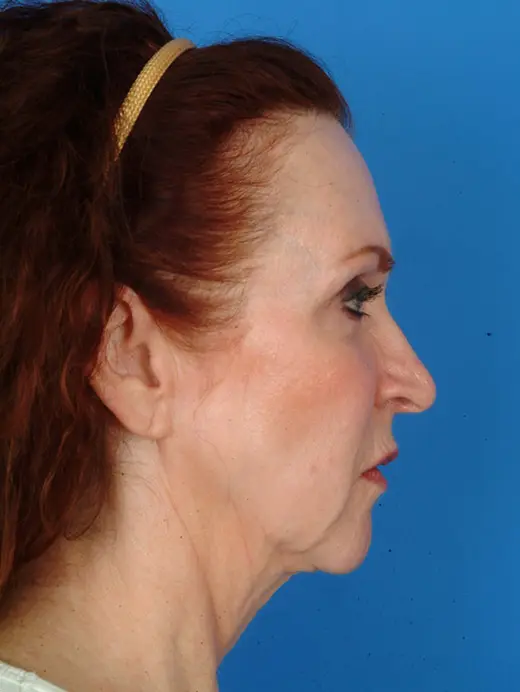 Multiple-Procedures-Work-Well---8211--Case-11587 | Before Brow Lift