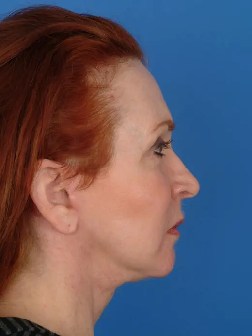 Multiple-Procedures-Work-Well---8211--Case-11587 | After Brow Lift