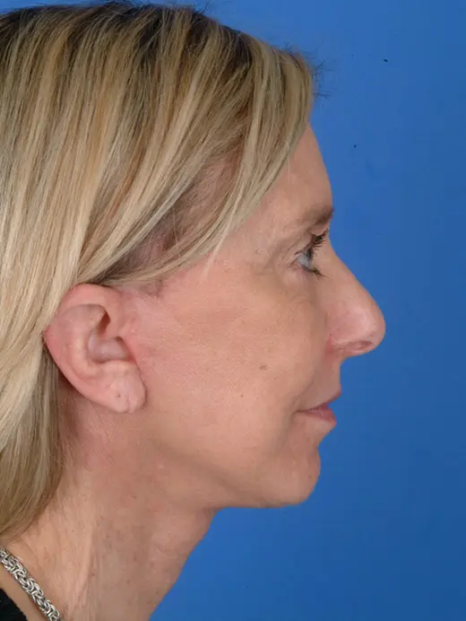 60 year old facelift surgery. 11590 profile view post op