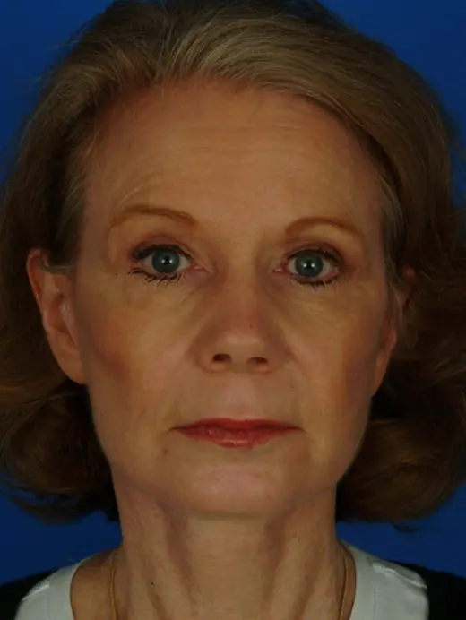 Facelift, upper eyelid surgery, cheek augmentation. 11593 front view post op