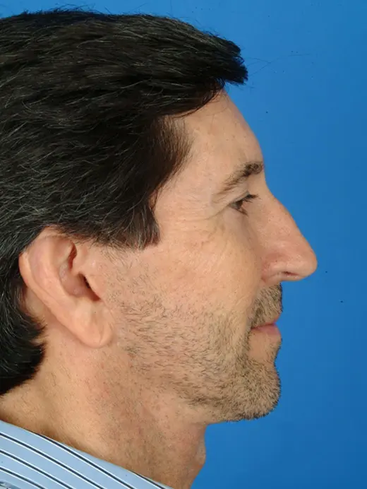 11678 Facelift with Browlift, and Lower Eyelid Surgery. Profile view 1 Year Post Op