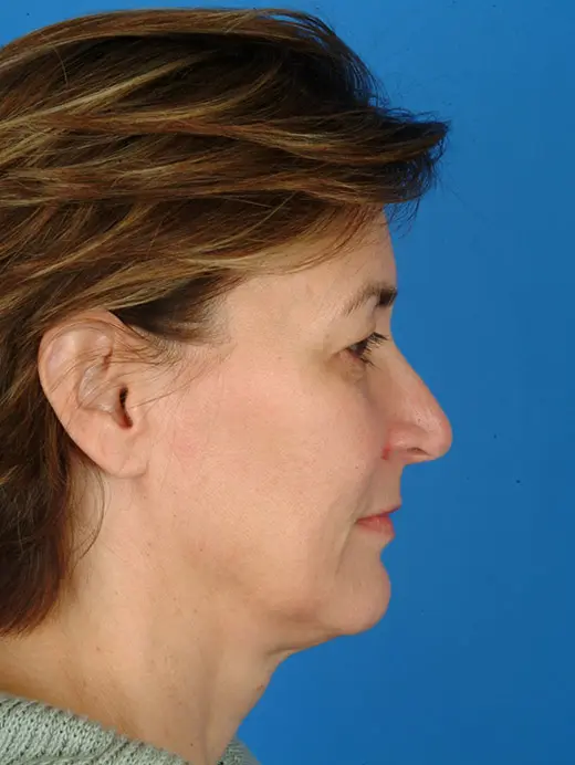 Facelift--Browlift--and-Bleph | Before Rhinoplasty