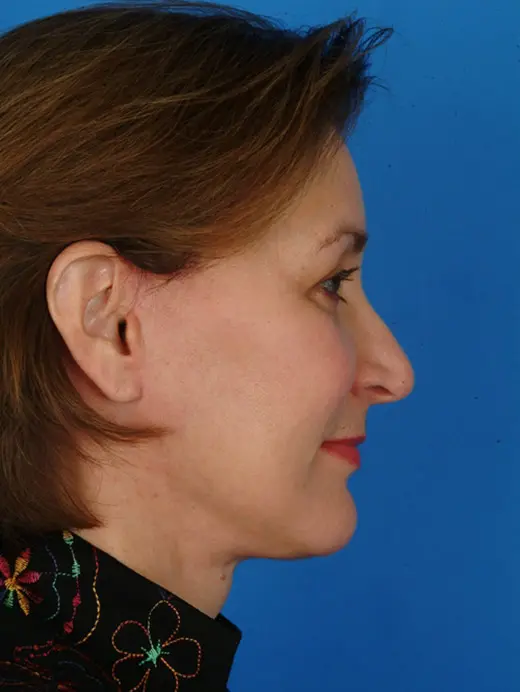 Facelift--Browlift--and-Bleph | After Rhinoplasty