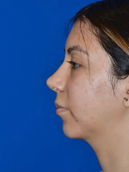 Nose Reshaping Rhinoplasty 78995 Post Side