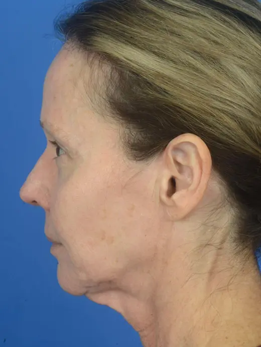 Laser Skin Resurfacing Facelift Facial Wrinkles Rhytidectomy 