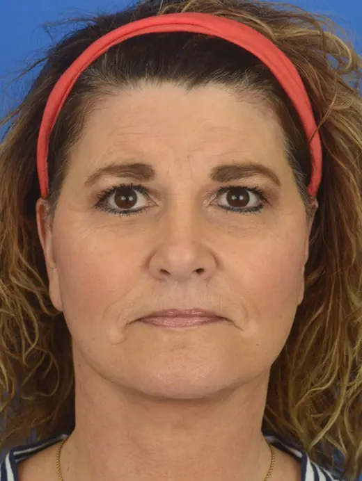 Submental Liposuction Facelift Rhytidectomy MVP Lift Facial Rejuvenation. 81630 Front view post op