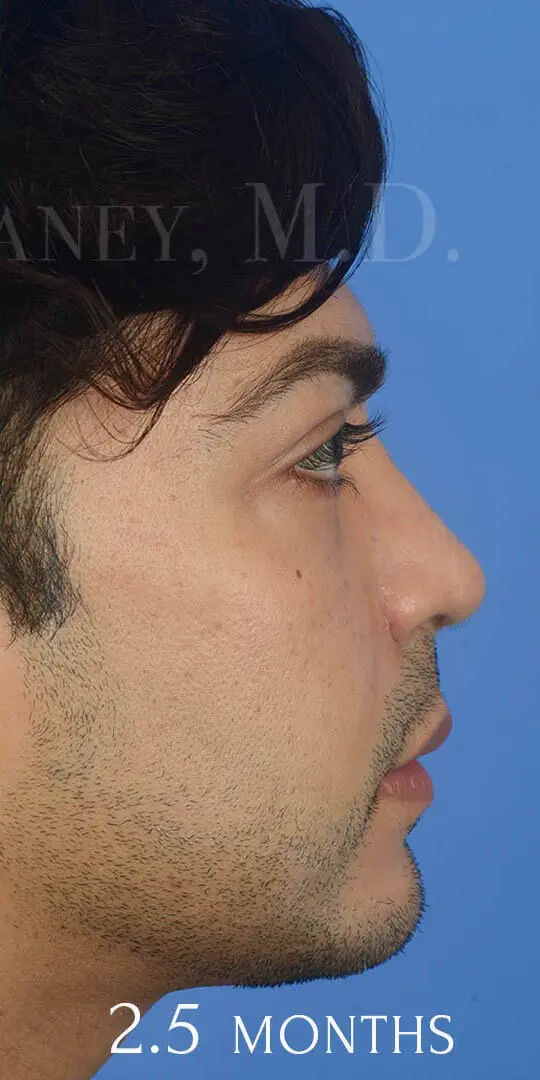 Ethnic Rhinoplasty 85184 Profile Post