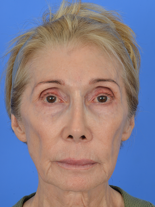 Case--9127 | Before Facial Fat Transfer