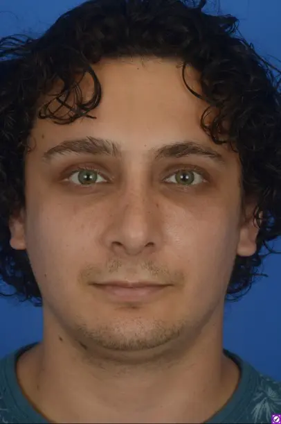 Case--4724 | After Revision Rhinoplasty