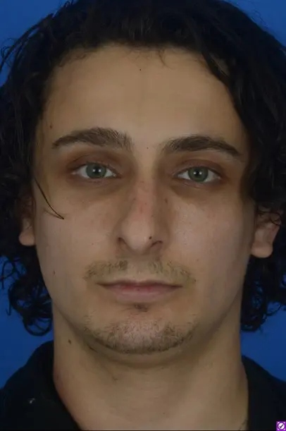 Case--4724 | Before Revision Rhinoplasty