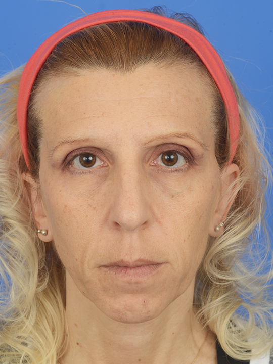 Case--4412 | Before Ethnic Rhinoplasty