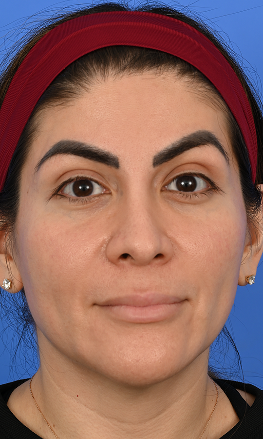 Case--5776 | Before FaceTite™