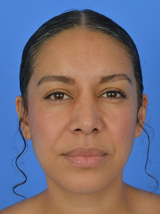 Case--6543 | After Brow Lift