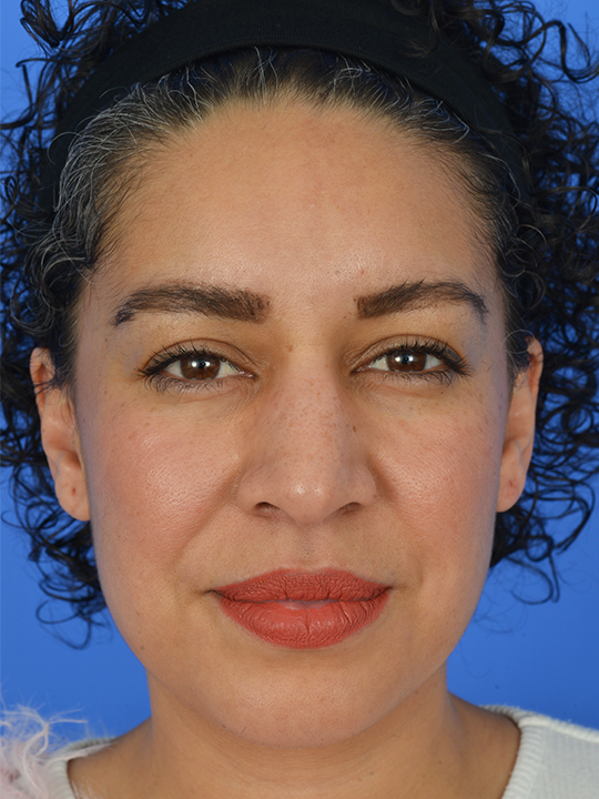 Case--6543 | Before Brow Lift