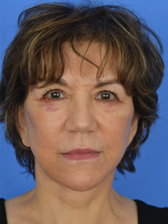 Case--6647 | After Laser Skin Resurfacing