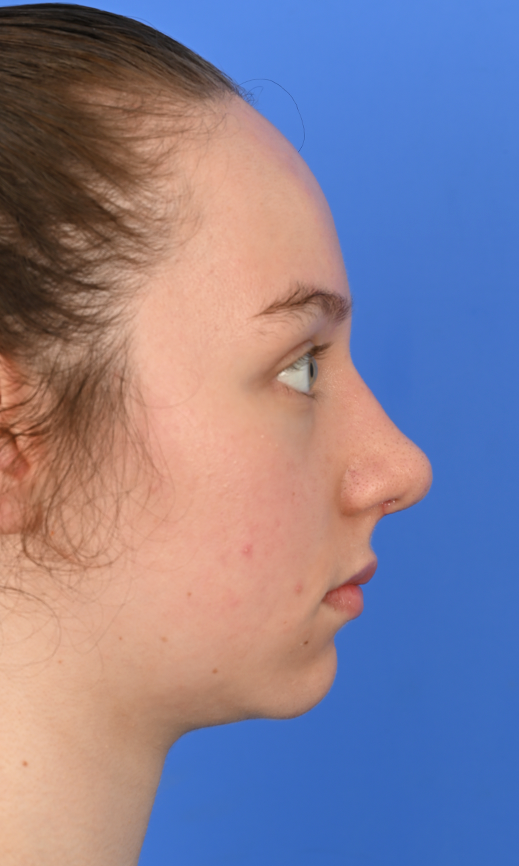 Case--3973 | After Ethnic Rhinoplasty