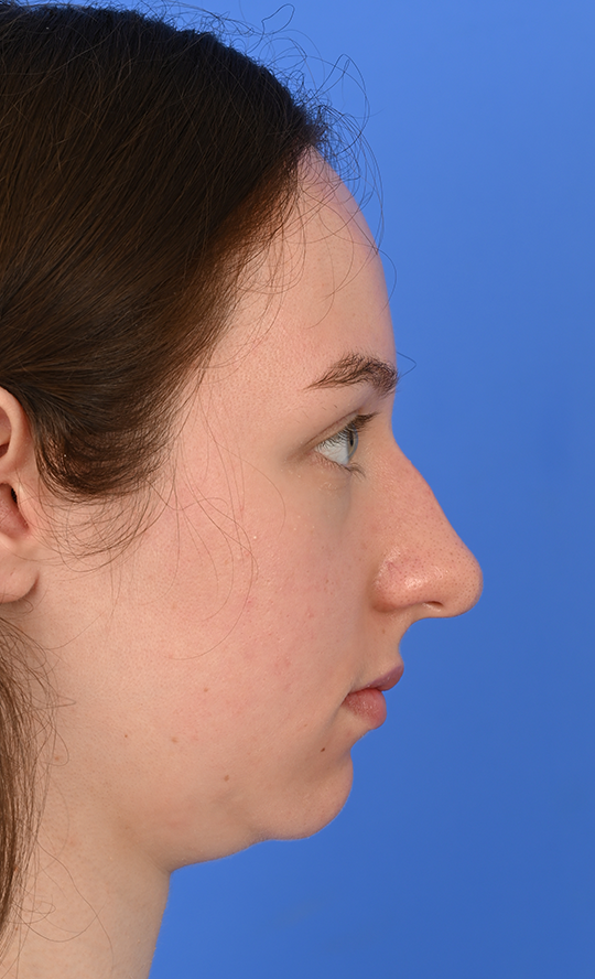 Case--3973 | Before Ethnic Rhinoplasty
