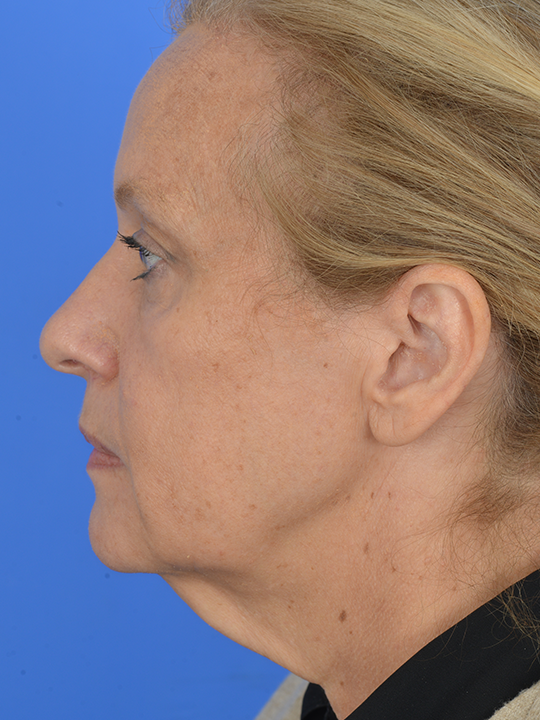 Case--9226 | Before Ethnic Rhinoplasty