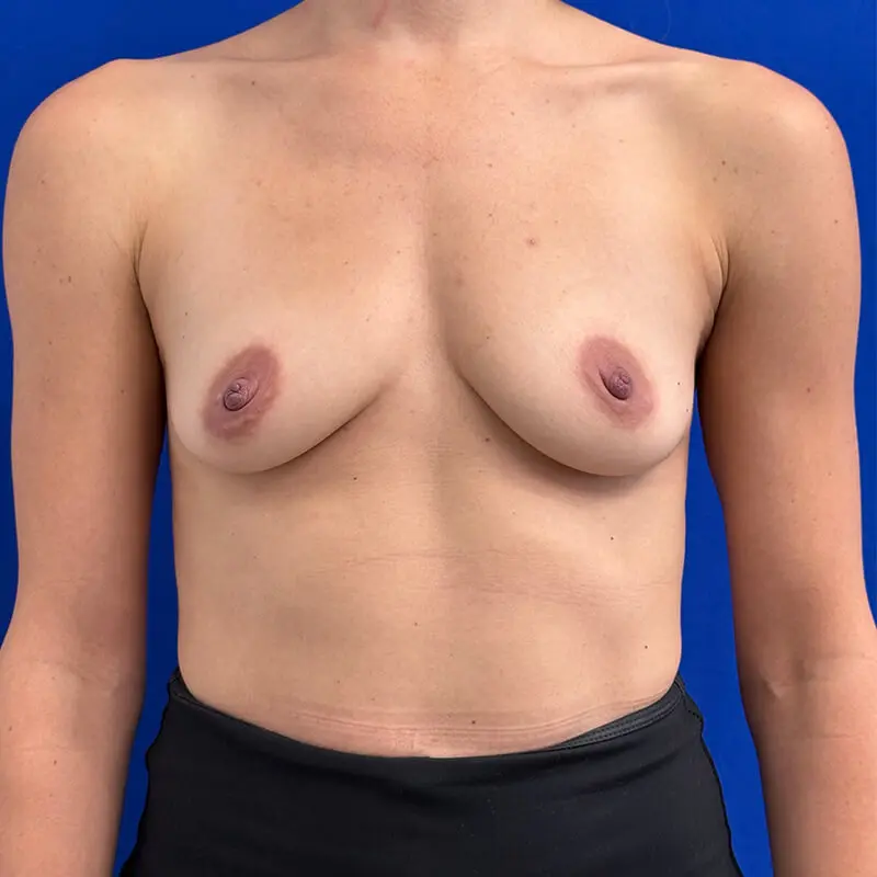 Patient Before & After Photo