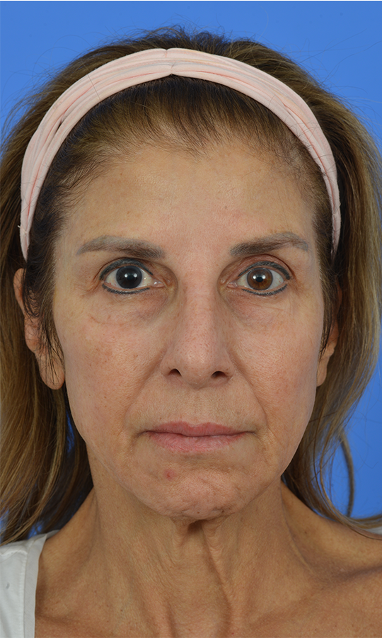Case--4396 | Before Rhinoplasty