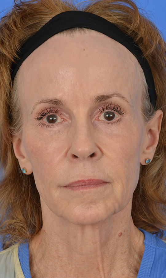 Case--9699 | Before Central Neck Lift